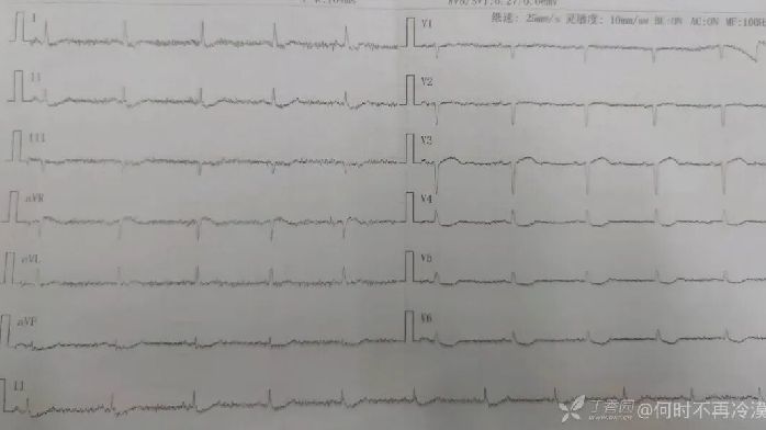 胸痛仅 1 天，心肌酶、肌钙蛋白均正常，却抢救无效死亡